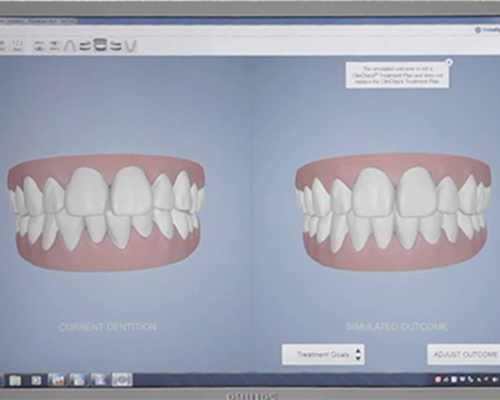 Invisalign Ergebnissimulator auf dem iTero Scanner