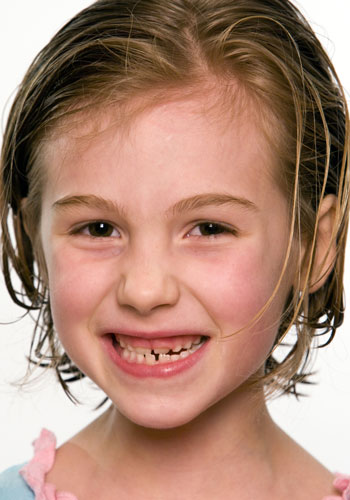 Invisalign First