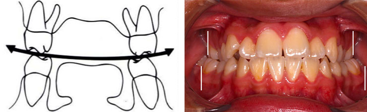 MSE II expander Dr. Moon (Maxillary Skeletal Expander) - Medical