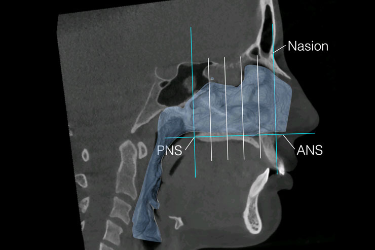 Maxillary Skeletal Expansion treatment · relax & smile® · Sanfte Kieferorthopädie Dr. Ana Torres Moneu & Dr. Christoph Moschik